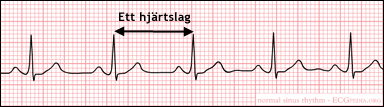 Elektrokardiogram (EKG)