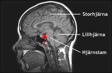 MRI-bild som visar hypothalamus