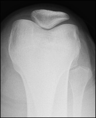 Röntgenbild av knä