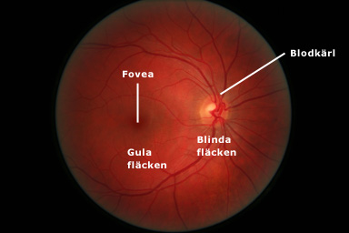 Höger näthinna sedd genom ett oftalmoskop